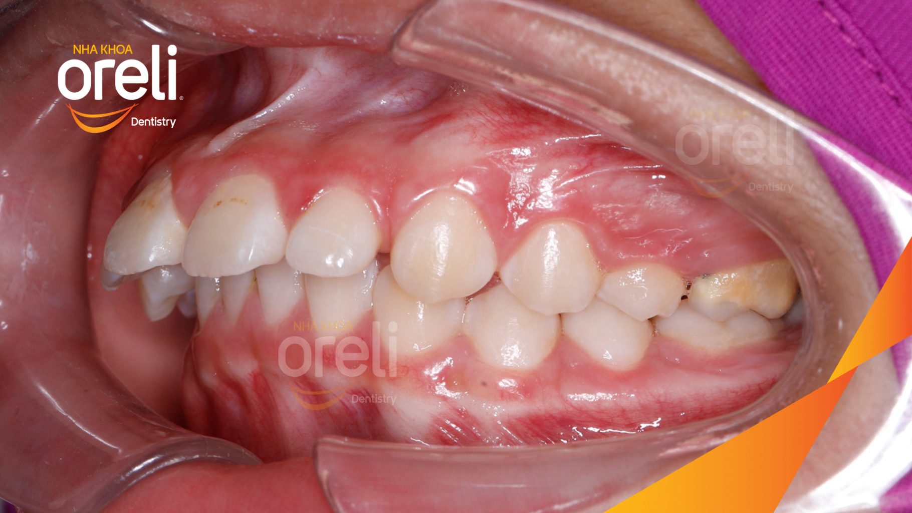 Kết quả sau 24 tháng: Trục răng cửa cải thiện giảm hô nhiều nụ cười hài hòa cân đối hơn tại Nha khoa Oreli